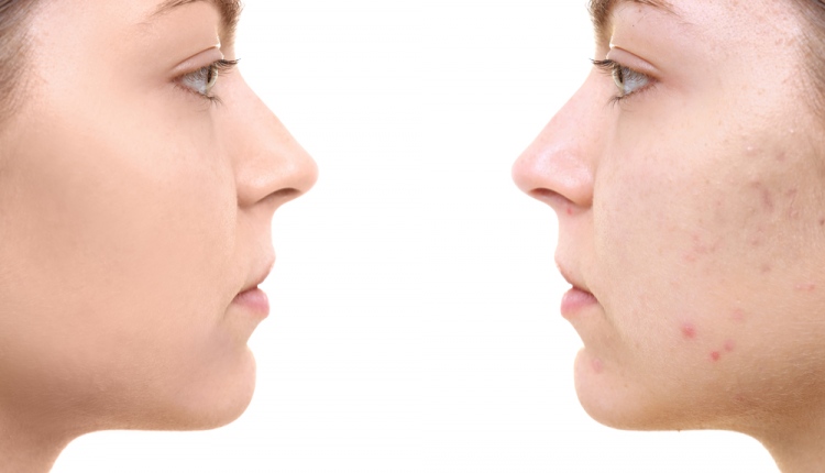 How Vitamin B5 Could Help People With Acne