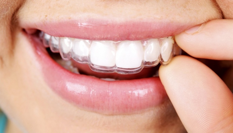 Pros and Cons Of Invisalign For Adults