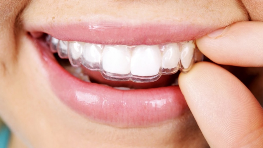 Pros and Cons Of Invisalign For Adults